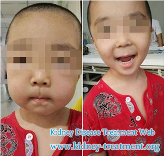 treatment for a 4 years girl, nephrotic syndrome, alternative treatment