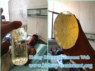 How to Eliminate Protein leakage in IgA Nephropathy with Creatinine 3.15