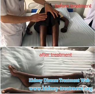 How to Deal with Edema for Diabetic Nephropathy Patients with Creatinine 206.51