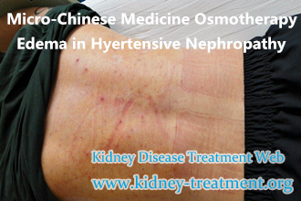 What To Do with Creatinine 6.9 and Edema in Hypertensive Nephropathy