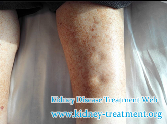 Creatinine 2.5 in Diabetic Nephropathy How to Treat Swelling