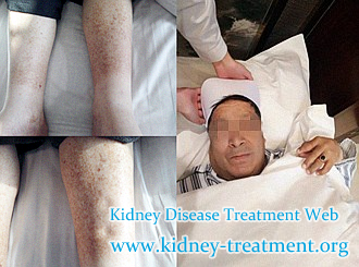 Is It Normal That the FSGS Patients Have Swelling in Legs