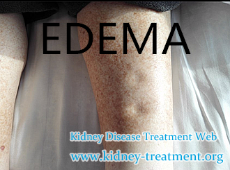 Would Edema Be Relieved Naturally in Nephritis With Herbal Medicine