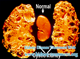 PKD and Creatinine 169 How to Stop Its Development