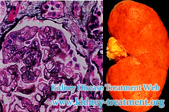 How Can We Get Rid of the Frequent Fever in Lupus Nephritis
