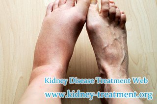 Swollen Feet,Lupus Nephritis