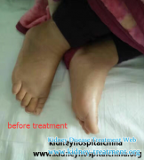 Diabetic Nephropathy Can Be Reflected By the Skin Manifestations