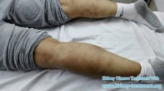 Skin Manifestations Reflect the Diabetic Nephropathy