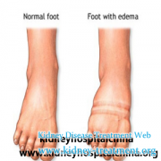 Some Edema Symptoms May Show Your Damage In Kidney Or Other Organs