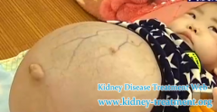 How To Treat Edema Of Children With Nephrotic Syndrome Effectively